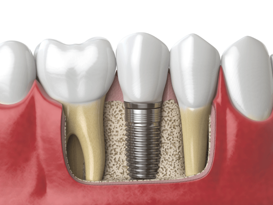 dental implants mccrae